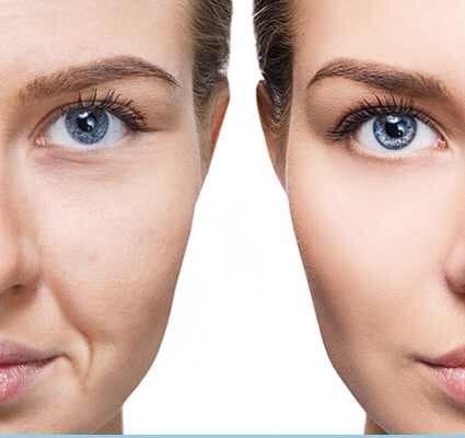 Tratament riduri botox